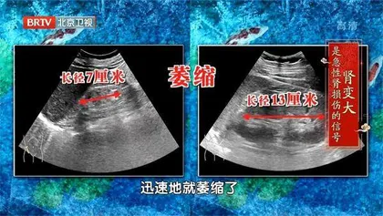 小心急性肾损伤盯上老年人2
