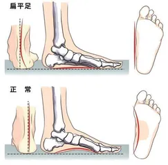 如何预防青少年扁平足