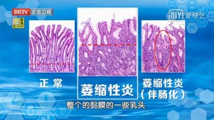 胃酸过低癌敲门5