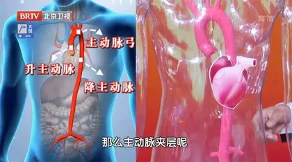 凶险的主动脉夹层2