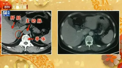 良性肿瘤缘何危及生命1