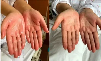 你了解手汗症吗?2
