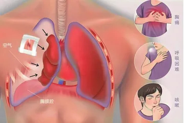 了解青少年气胸手术