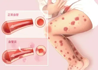 如何预防儿童过敏性紫癜？