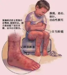 如何预防儿童过敏性紫癜？1