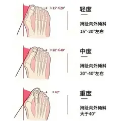 了解青少年拇外翻