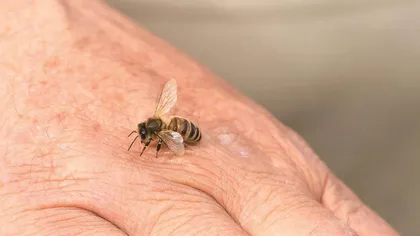 蜂蛰伤的中西医急救方法