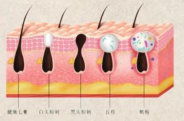 青少年要如何应对青春期痤疮？1