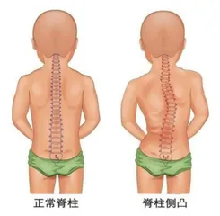 青少年脊柱侧弯的防治措施