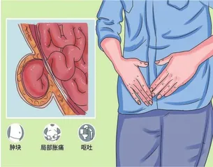 认识儿童腹外疝
