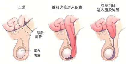 认识儿童腹外疝1