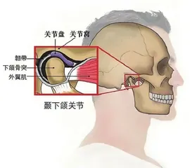 青少年牙齿矫正过程中，颞下颌关节病不容忽视1