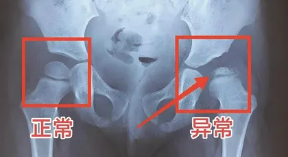 儿童股骨头坏死的治疗和预防1