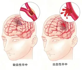 青少年脑卒中的预防与护理