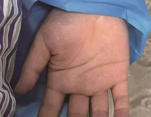 手汗多不是小毛病，深入带你了解手汗症