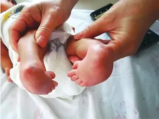 青少年马蹄足内翻患者手术护理
