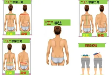 青少年脊柱侧弯居家“工”字筛查法