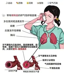 中医治疗青少年支气管哮喘1