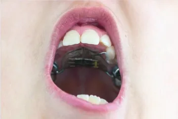 青少年错颌畸形的危害与矫正3