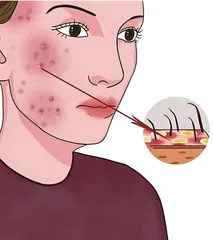 青少年脂溢性皮炎的中医治疗