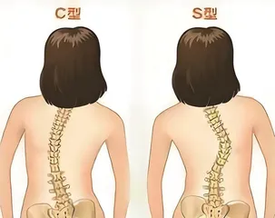 青少年脊柱侧弯的早期发现与矫正1