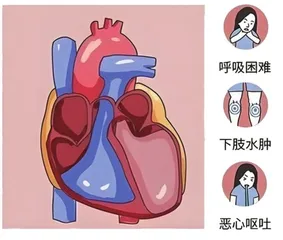 心力衰竭的管理：生活方式改变与药物治疗相结合
