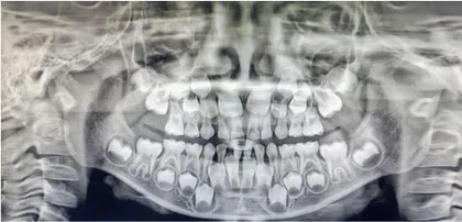 儿童口腔健康护理要点有哪些?1