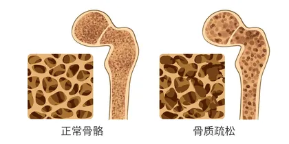 预防骨质疏松应从青少年做起1