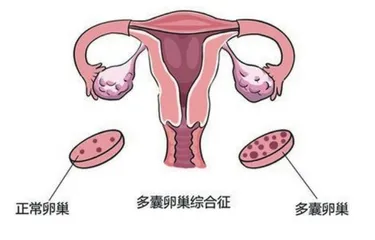 多囊卵巢综合征女孩如何进行自我调理？