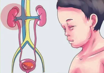 儿童肾脏疾病1
