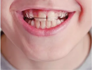 青少年口腔正畸治疗须知