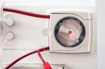 血液透析为尿毒症患儿打开生命通道1