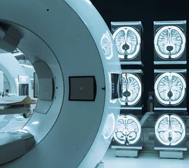 青少年脑部先天性大血管畸形术后的保养要点