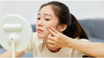 青春有“痘”，不必苦恼