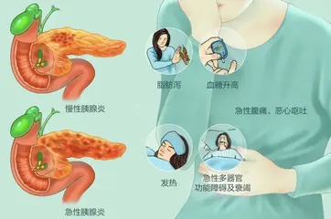 中西医结合治疗青年急性胰腺炎