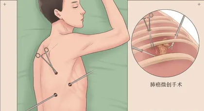 如何提高青少年肺癌患者术后生存时间和生活质量1