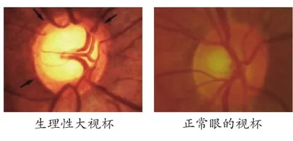 双眼生理性大视杯，要紧吗？