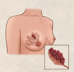 青少年乳腺癌如何治疗？
