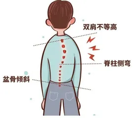 青少年脊柱侧弯的预防和治疗