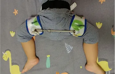 青少年髋关节发育不良如何进行康复训练?1