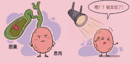教你认识胆囊息肉以便早发现、早干预1