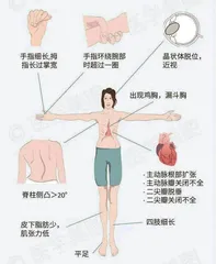 马方综合征，你了解吗？