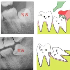 智齿那些事1