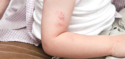 青少年带状疱疹后遗神经痛的预防和治疗