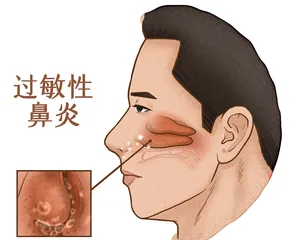 别以为鼻塞都是过敏惹的祸