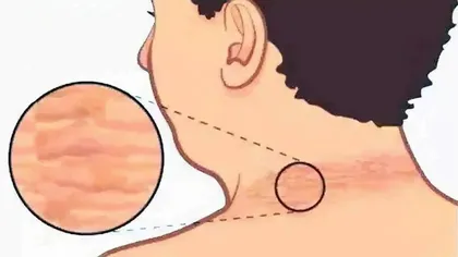 脖子发黑洗不净，当心患黑棘皮病
