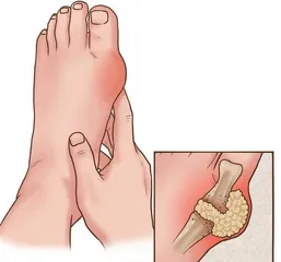 痛风性关节炎