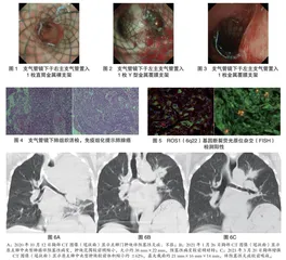 支架植入联合靶向药物治疗晚期肺癌1例报道