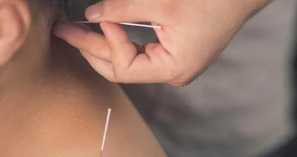 颈源性头痛的针灸治疗及保健 