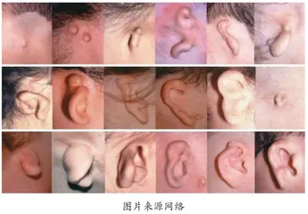 孕妈妈产前彩超有必要检查外耳畸形吗